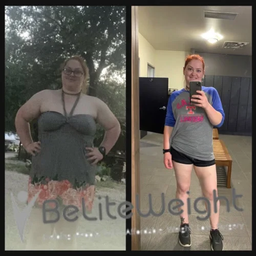 Weight Loss Surgery Before And After